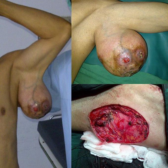 Lipoma