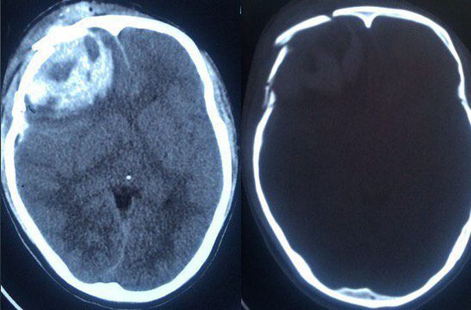 Intracranial haemorhagic with depressed skull fracture 