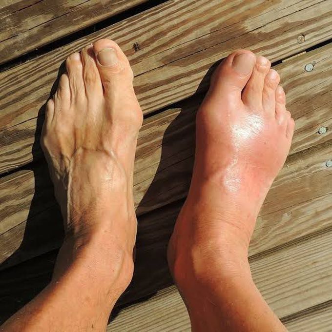 What is gout?