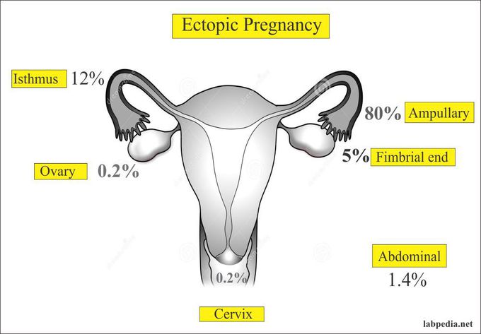 Sites of Ectopic Pregnancy
