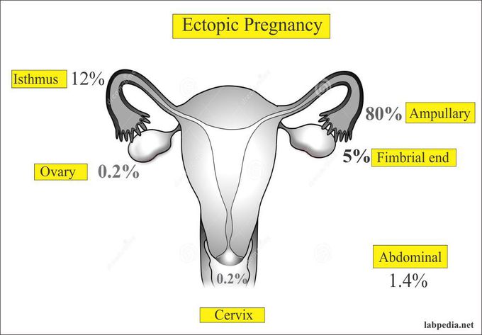 Sites Of Ectopic Pregnancy Medizzy