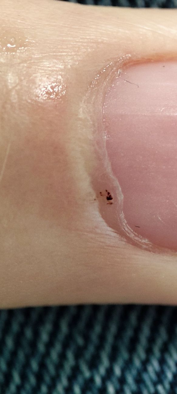 What can be this in my finger near the nail ? Should i wory - MEDizzy