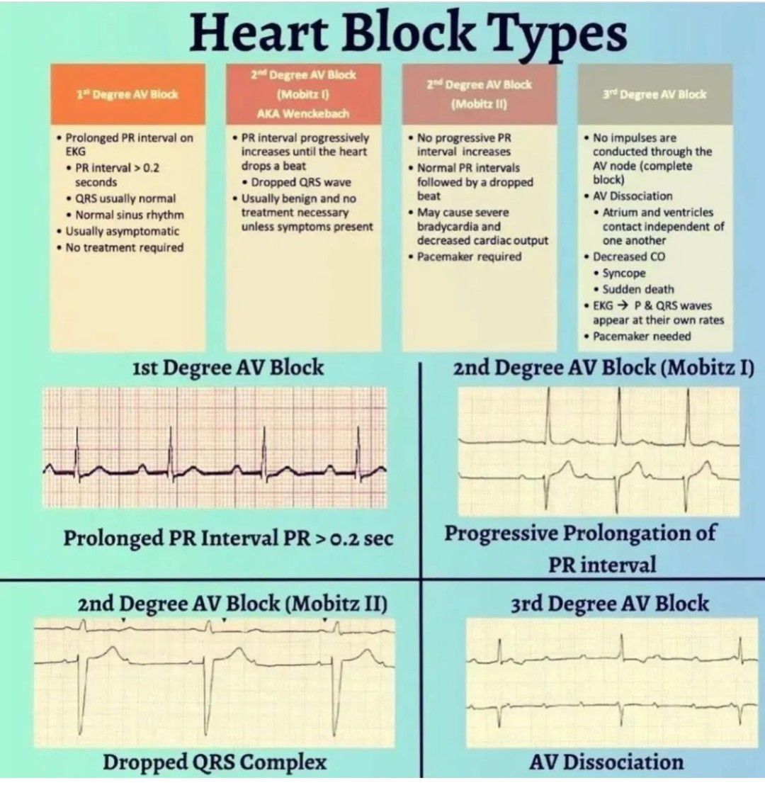 Heart Block Types - MEDizzy