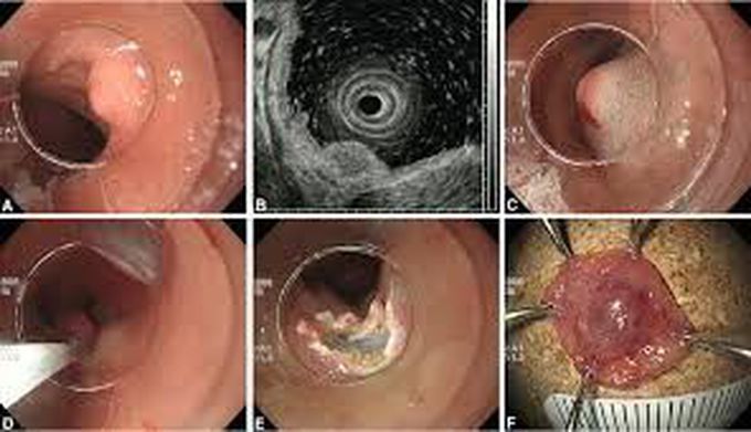 Endoscopic mucosal resection