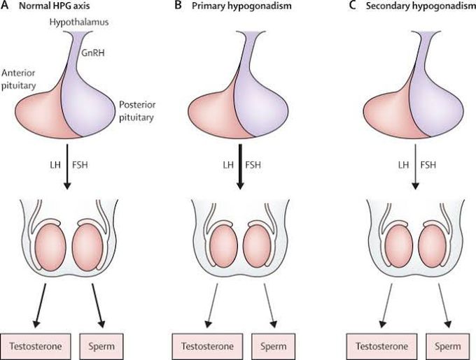 Causes of male hypogonadism