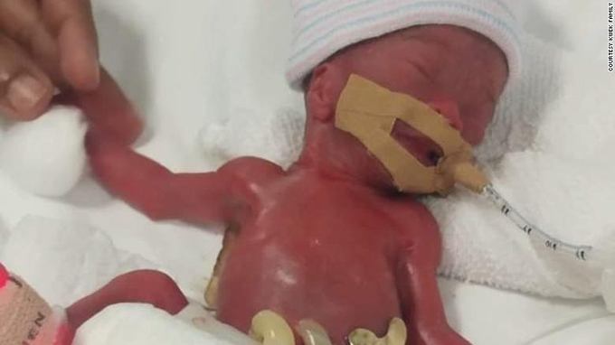 The Survival Story of the World's Smallest Baby Weighing 7.5 Ounces