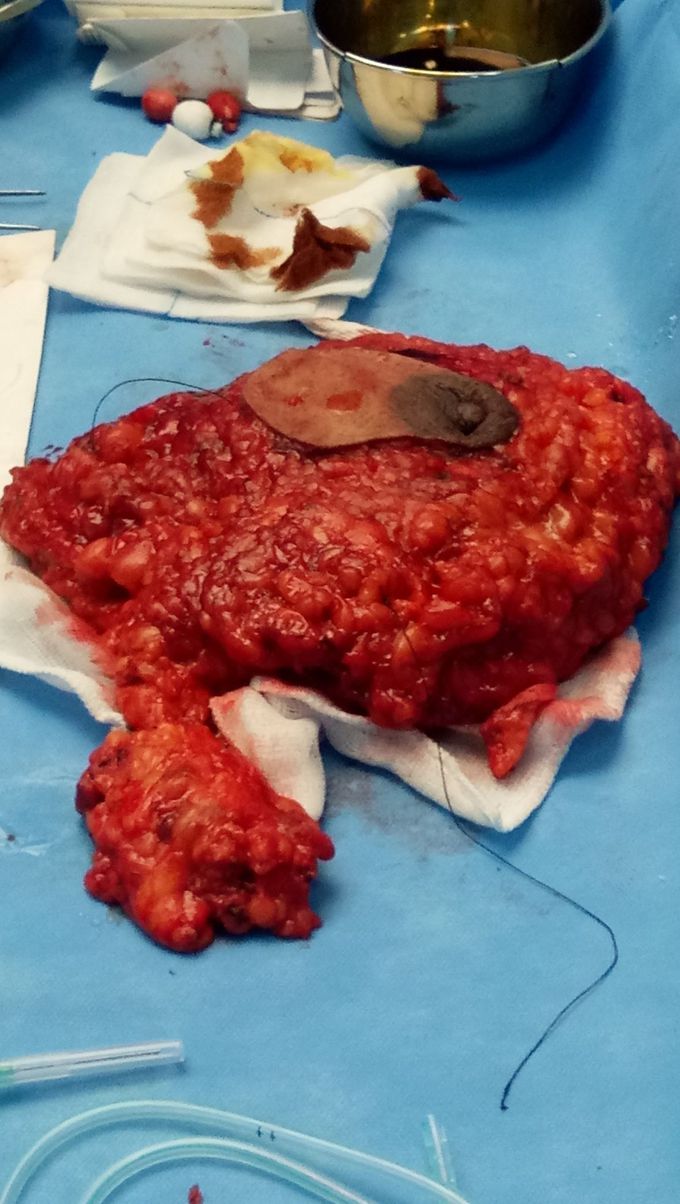 Breast cancer