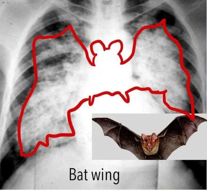 Bat Wing Sign