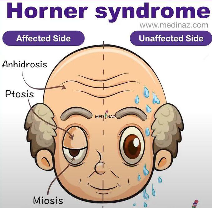 Horner Syndrome