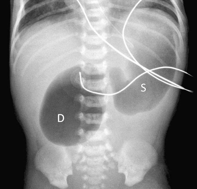 The Double Bubble Sign: This radiograph of the abdomen demonstrates a dilated stomach & an accompanying dilated proximal duodenum. There is no gas in the bowel distal to the dilated duodenum. This is called the "double bubble" sign and usually indicates the presence of duodenal atresia.