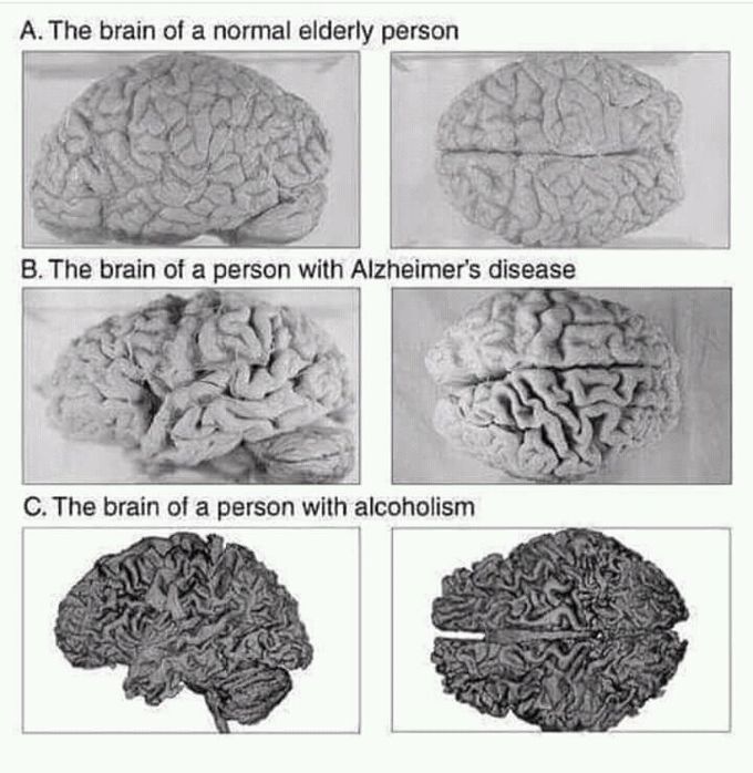 Alcoholism is a very serious condition causing damage to every organ in the body starting from liver to the brain.