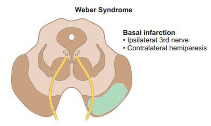 Causes of Weber syndrome
