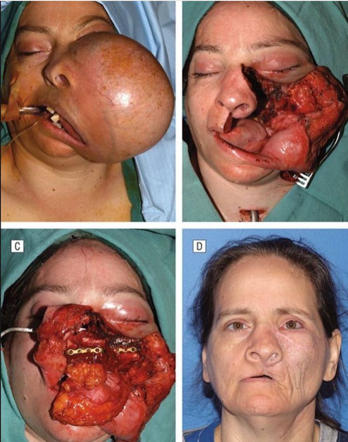 Discretion⚠️Ameloblastoma⚠️💀🔪