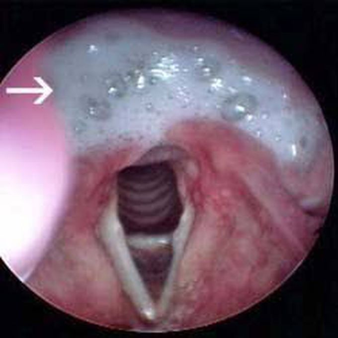 Cricopharyngeal spasm