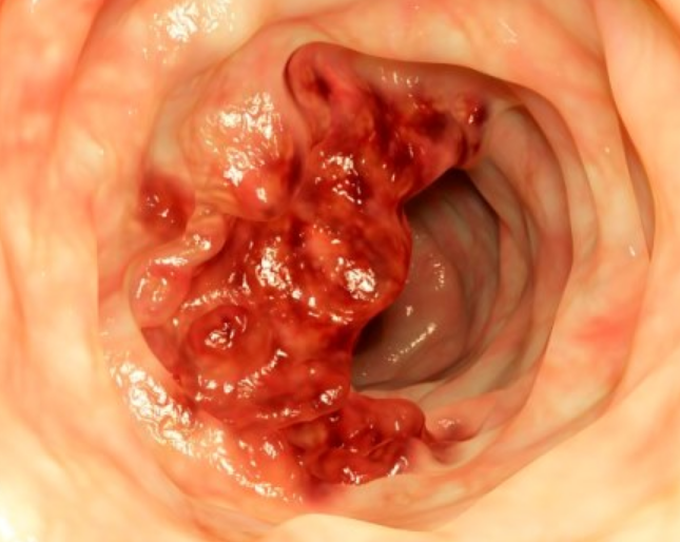 BOWEL CANCER SIGNS AND SYMPTOMS