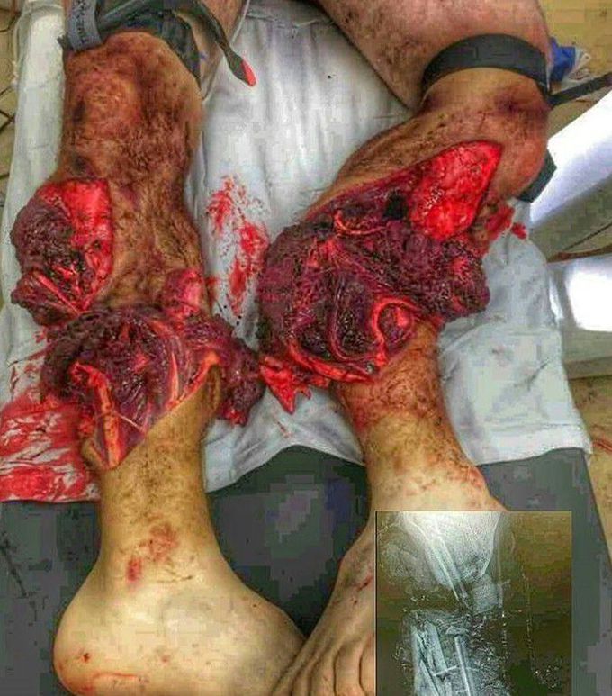 Amputation of Lower Limbs