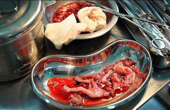 This is what remains of a fetus aborted "after its creation".💔