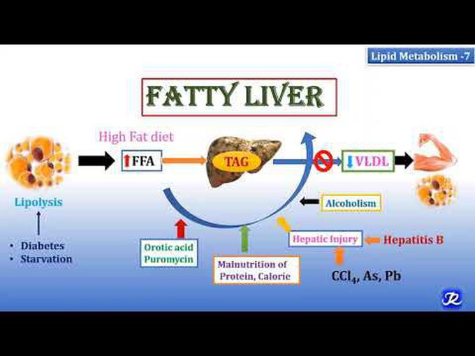 Deposition of excess triglycerides in hepatocytes-Fatty liver