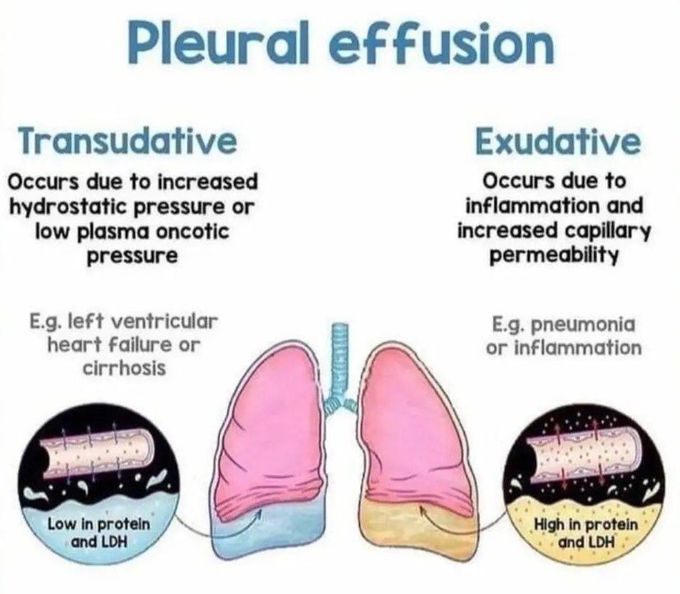 Pleural Effusion