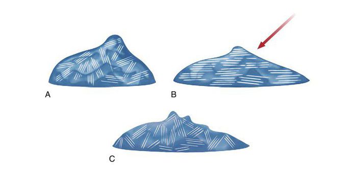 Pseudoplasticity