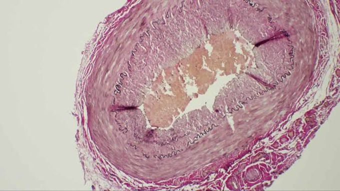 Medial calcific sclerosis