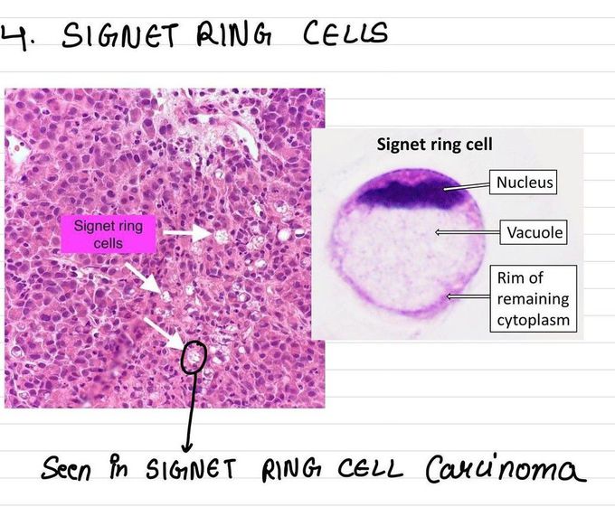 Signet Ring Cells