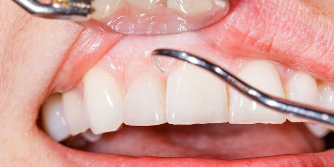 Treatment for White gums