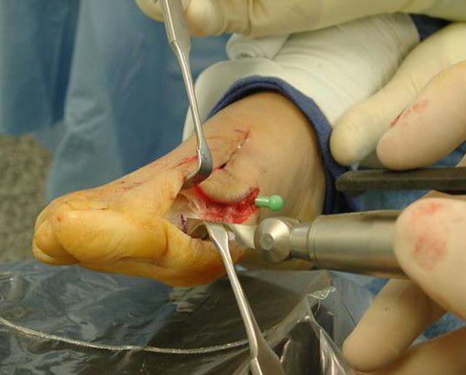 Bunion surgery