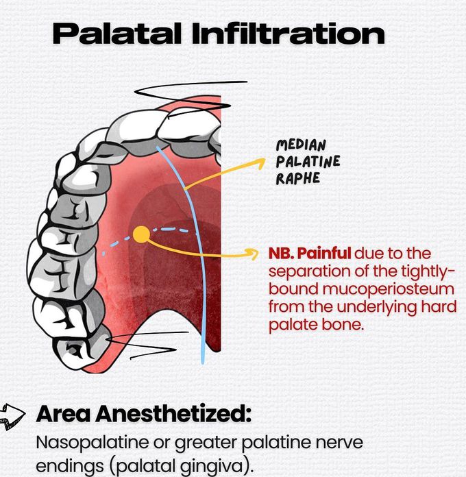 Maxillary Local Anesthesia I