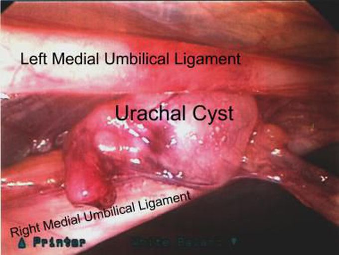 Laparoscopic removal of urachal cyst. View is from left lower abdomen port. The umbilicus is on the right and the bladder on the left. The attachments or the urachal cyst to the bladder and the umbilicus have been clipped (not shown) and divided. Note the convergence of the right and left medial umbilical ligaments as they approach the umbilical ring on the right.