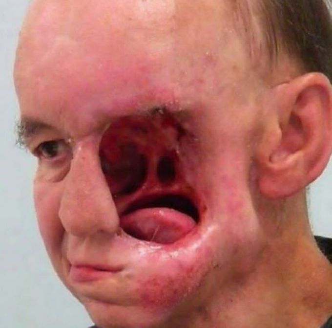 EXTENSIVELY EROSIVE CANCER :