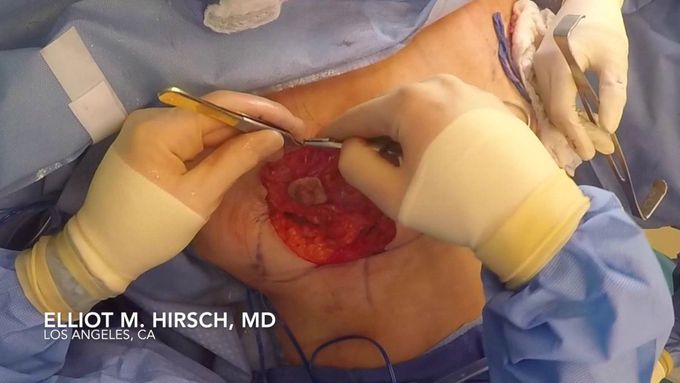 Breast implant removal, total capsulectomy, and breast lift