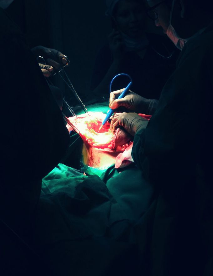 Open Incisional Hernia Repair!