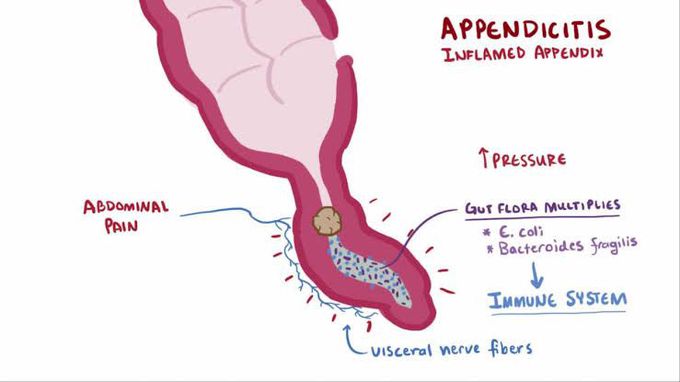 Appendicitis