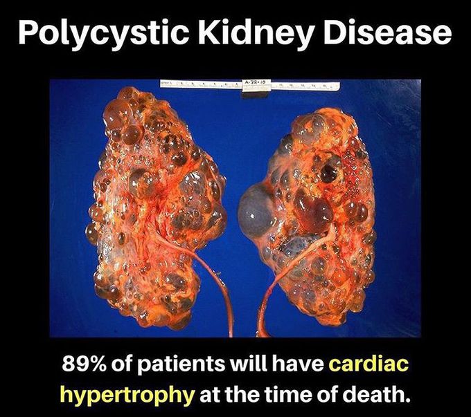 Patients are at increased risk for infection, stones, valvular disease, hemorrhagic CVA. ESRD will occur in half the patients over 50.