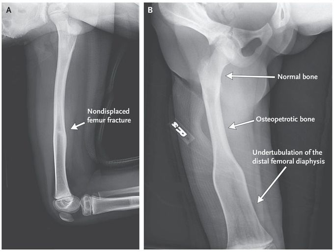 Osteopetrosis and Erlenmeyer-Flask Deformity