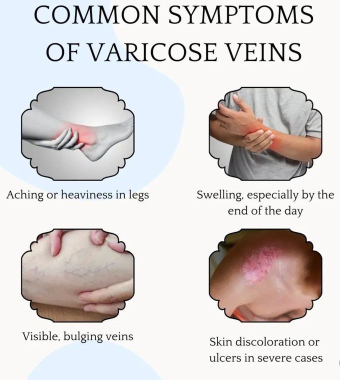 Varicose Veins II