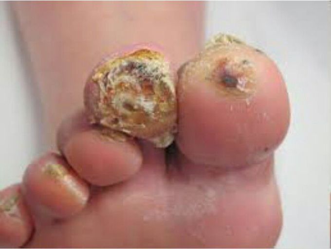 Diabetic Foot Ulcer