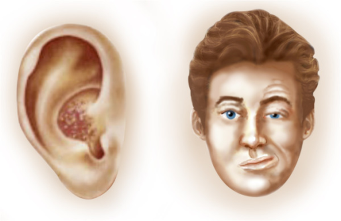 Ramsay Hunt Syndrome: A Rare Condition