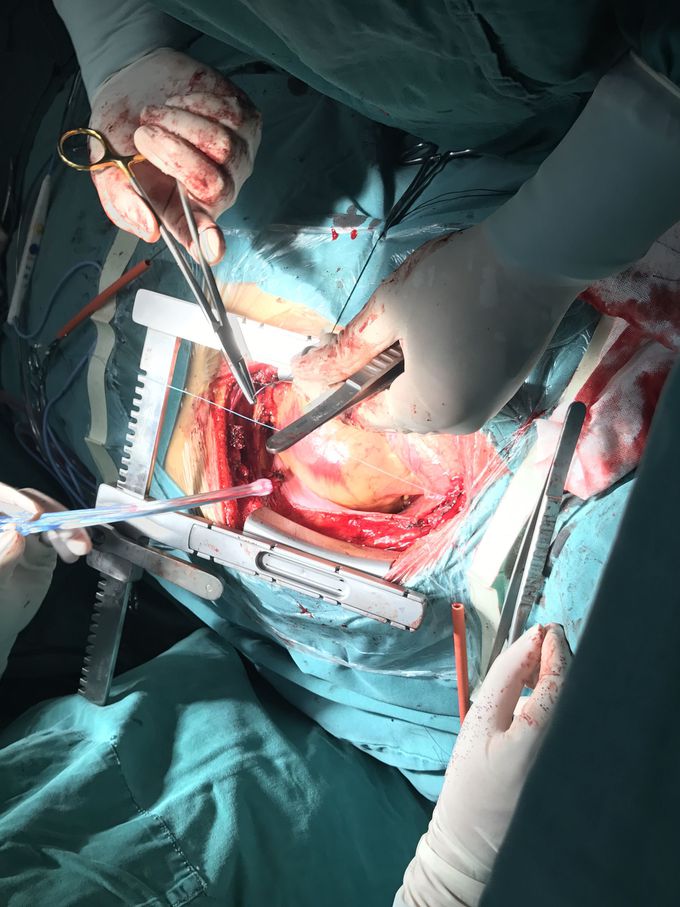 Open heart surgery