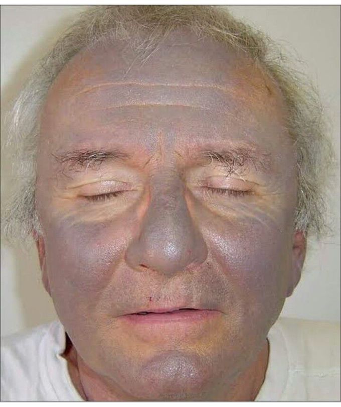 Argyria