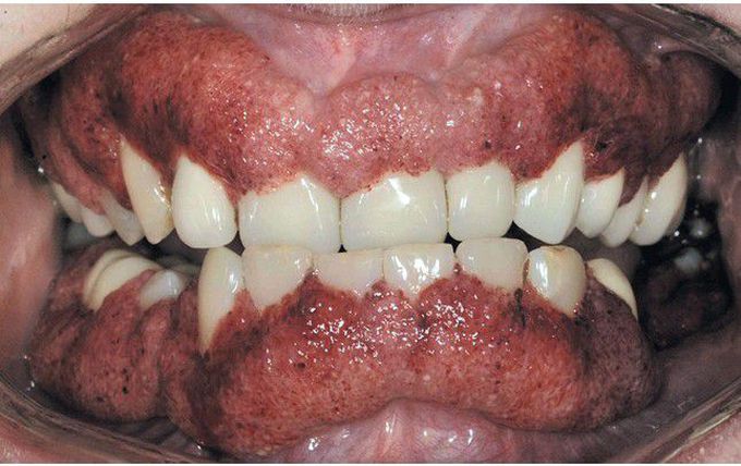 Wegener Granulomatosis.