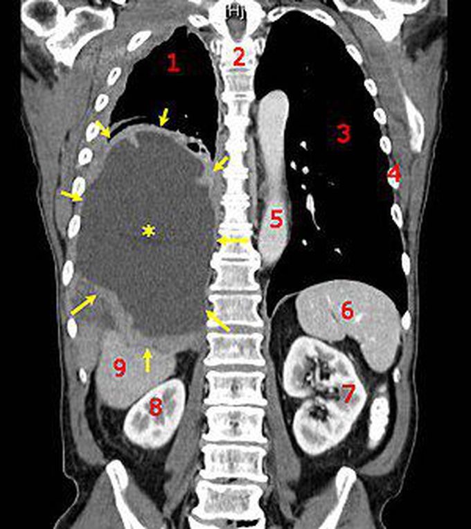 Malignant mesothelioma