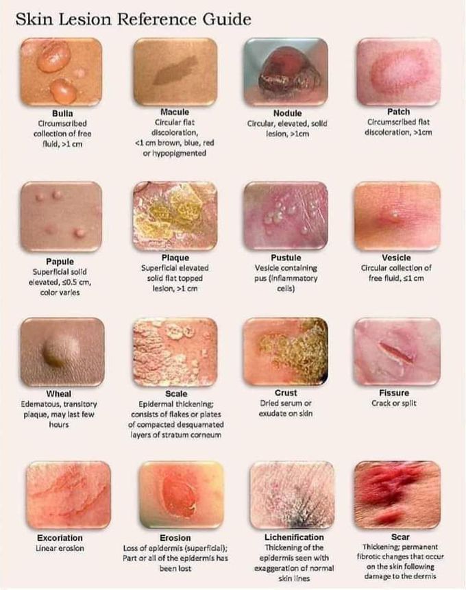Skin lesion