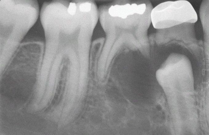 Odontogenic Keratocyst (OKC).