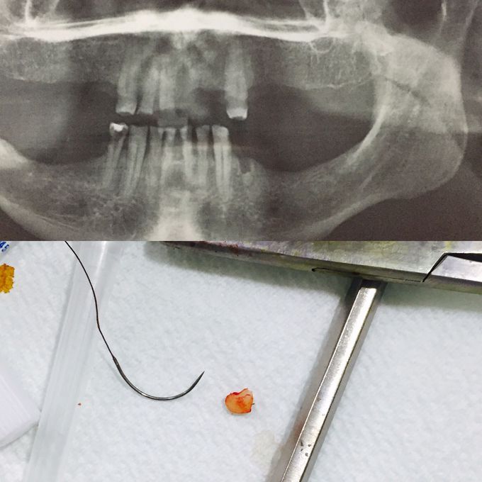 removal of the root left in the apex💉💀