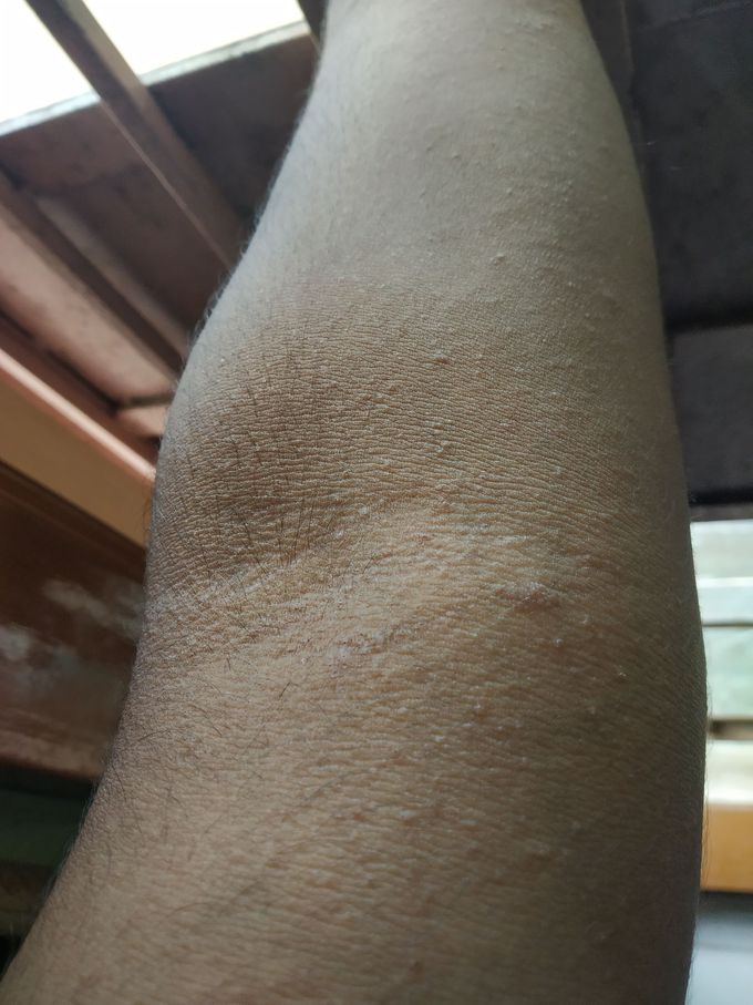 What is the diagnosis and treatment?