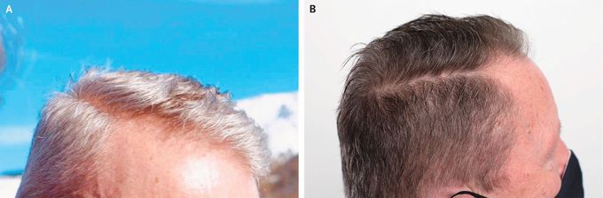 Hair Repigmentation Induced by Nilotinib