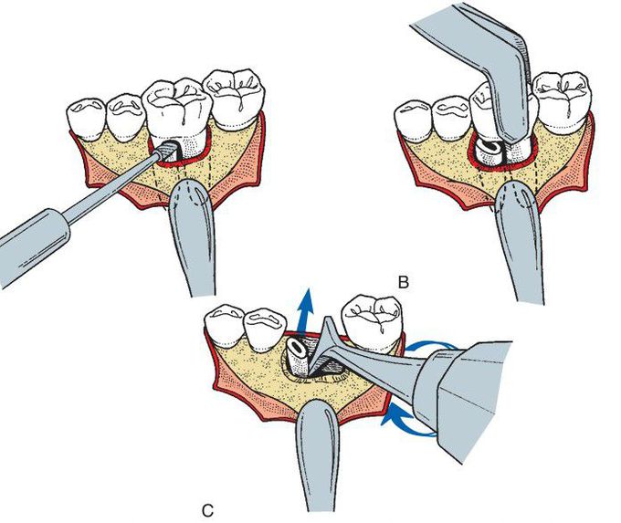 Sectioning the tooth