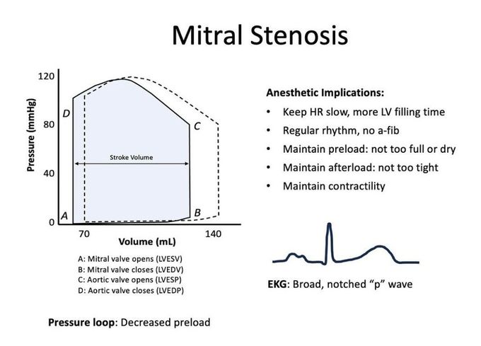 Mitral Stenosis I
